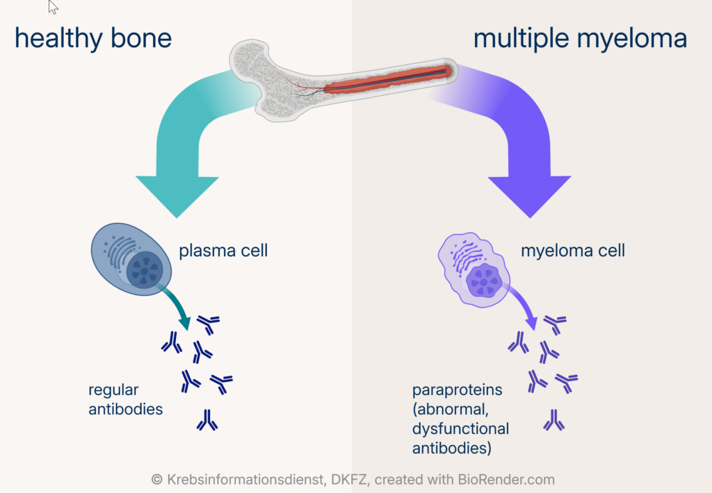 Schematic representation of a bone with bone marrow, healthy plasma cells and myeloma cells.